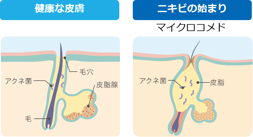 ニキビの原因1