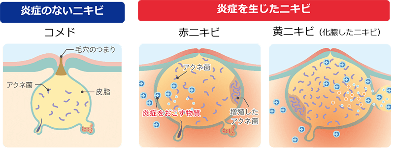 ニキビの原因2