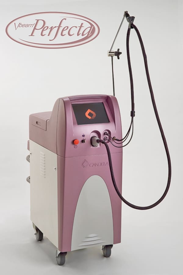 Vビームレーザーとは